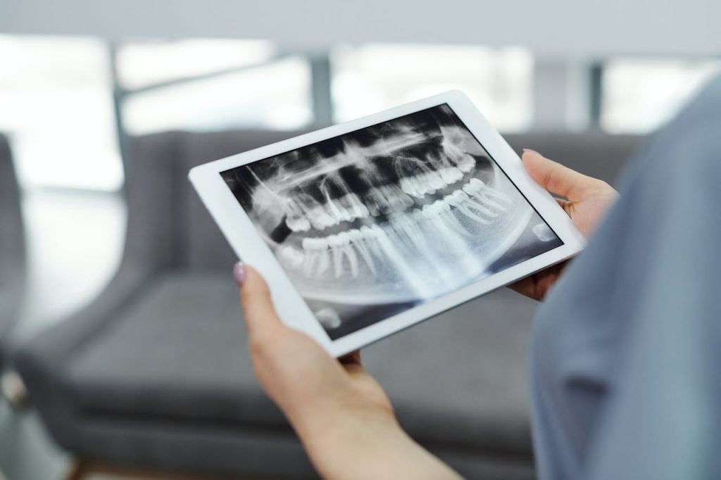 Are Dental Implants Covered By Insurance
